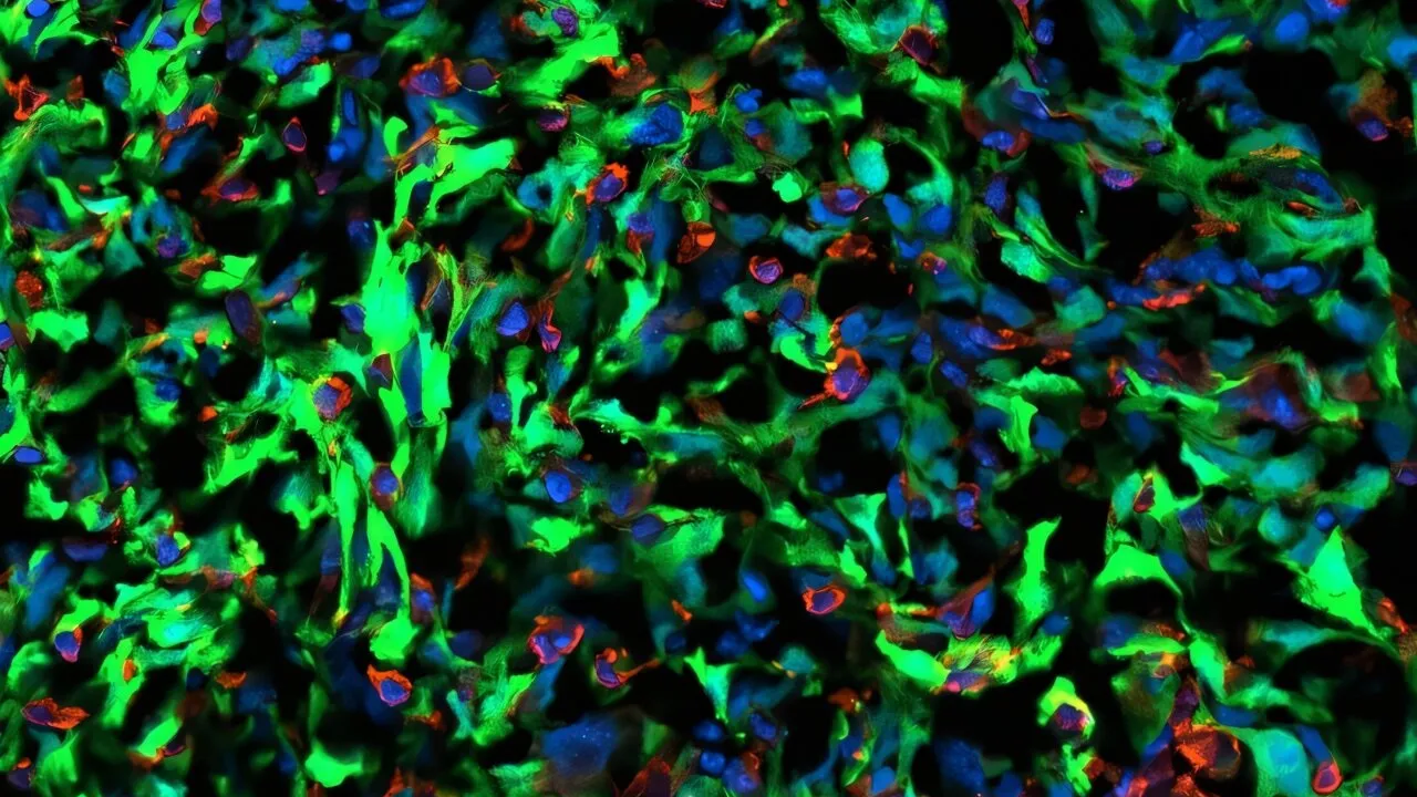 Príbeh: Dnes ma zaujalo ako sa šíri rakovina metastázami do mozgu a čím ju zastavíme alebo resetujeme astrocyty, ktoré sú len tuk ako podpora neurónov